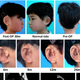 A six-year-old girl, seen above, is the first person to have a new ear successfully made from her own cells. Photo: Cao et al/EBioMedicine